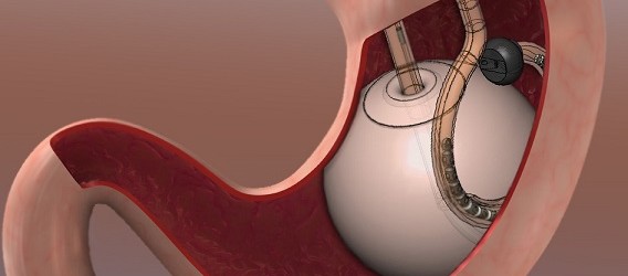 Intragastric balloon